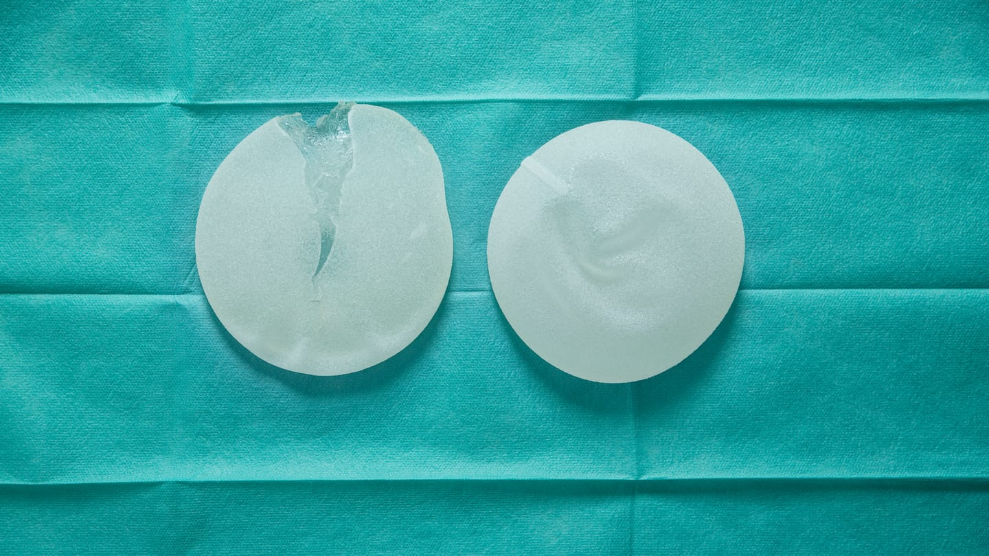 Risky breast operations: ruptured and intact implants